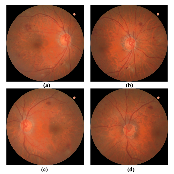 Fundus images. (a) Macular-centered right eye, (b) Optic disc-centered right eye, (c) Macular-centered left eye, (d) Optic disc-centered left eye.